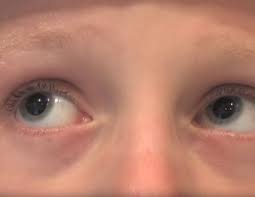 Check spelling or type a new query. Leber Congenital Amaurosis Diagnosis
