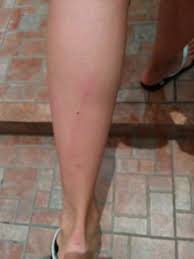 The Stretch Marks By The Massage Lady Picture Of Health Land Spa Massage Ekamai Bangkok Tripadvisor