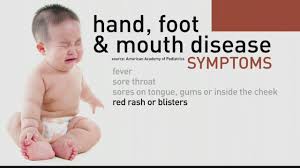 Visit the national agricultural library of the u.s. How To Treat Children With Hand Foot And Mouth Disease Youtube
