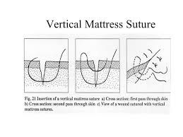 The advantages of the vertical mattress suture are that it provides closure for both deep and superficial layers, and also allows perfect eversion and vertical opposition of the superficial skin edges. Basic Suturing Techniques Ppt Video Online Download