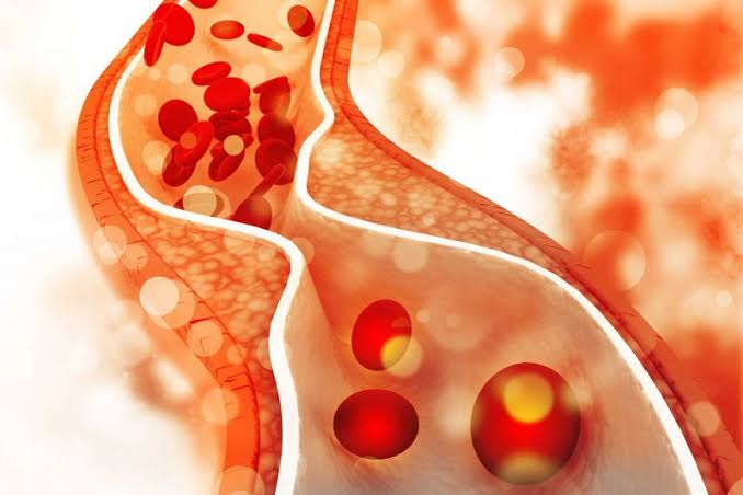 Cải thiện cholesterol máu cần chú ý 5 điều sau