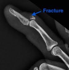 Mallet Finger Surgeon Dallas