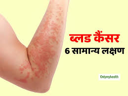 Blood cancer information including symptoms, diagnosis, treatment, causes, videos, forums, and local community support. What Causes Blood Cancer In Hindi