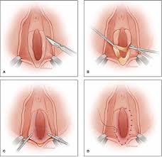 Image result for Localized Vulvar Dysesthesia