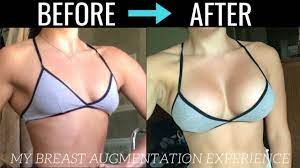 Check spelling or type a new query. Breast Augmentation Recovery Tips What To Expect