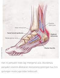 Salam doctor, saya mempunyai seorang anak lelaki yang mengalami keretakan tulang kaki kiri (buku lali) akibat terjatuh ketika bermain bola. Siapa Sekarang Sedang Lenguh Lenguh Walet Herbs Johor Facebook