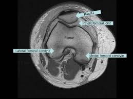 The muscles of the knee include the quadriceps, hamstrings, and the muscles of the calf. Axial Mri Of Knee How To Interpret Location Of Acl Pcl Step1