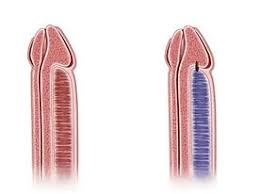 Image result for Priapism