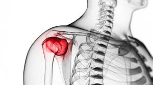 Image result for Chronic Shoulder Dislocation