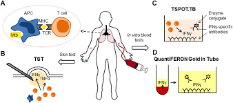 Qft provides the value of a robust technology, and offers physicians a more reliable and convenient tool for accurately identifying m. Figure 3 From Igras The Gateway To T Cell Based Tb Diagnosis Semantic Scholar