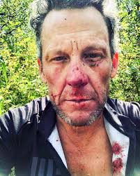 Lance Armstrong Posts Bloody Selfie After Fall