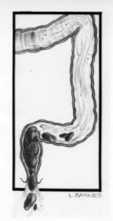 Image result for Encopresis