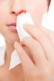 Trebuie un consult in sfera orl si cauza va fi depistata. Epistaxis Sangerari Nazale Primul Ajutor