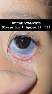 Image result for melanosis sclera