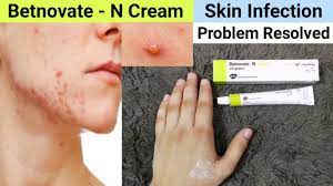 Betnovate N Cream Review Benefits Uses Betnovate N Cream For Face Acne Pimples Youtube Will it treat acne or is it harmful? answered by dr. betnovate n cream for face acne pimples