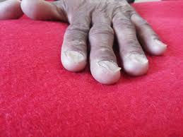 Here you see the spoon shaped nails condition is known as kolinychia, seen in iron deficiency anemia. Ladakhi Koilonychia Bmj Case Reports