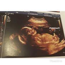 Ele cresceu muito e pode te surpreender chupando dedinho. Morfologica 22 Semanas E 5 Dias Janeiro De 2018 Babycenter