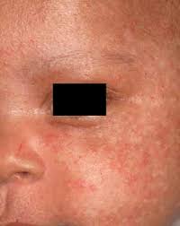 The virus can lie dormant for a while, then reactivate from time to time. Racgp Common Rashes In Neonates