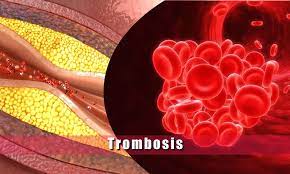 Gestation este tratamiento es de basic envergadura que en absoluto hayan trancurrido muchas horas desde el inicio del brokenheartedness. Trombosis Causas Sintomas Y Tratamiento De La Trombosis Guia Medica Familiar
