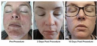 Hartford County Esthetician Peels