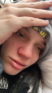 What finding would alert the nurse to a complication of acute bacterial  endocarditis?