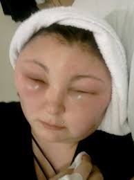 GALERIE: Oběť kosmetiky! Dívka (25) oslepla poté, co si nabarvila vlasy