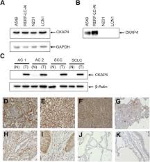 Certain colors of bms or stools can be a warning sign of cancer. Cytoskeleton Associated Protein 4 Is A Novel Serodiagnostic Marker For Lung Cancer The American Journal Of Pathology