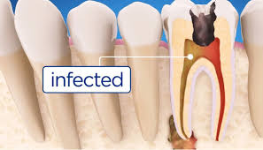 How to tell if you need a filling. History Of Root Canals Jackson Smiles Family Dentistry Jackson Tn