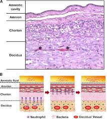 Image result for Chorioamnionitis