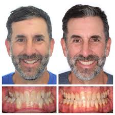 As a 48 year old adult I was nervous about getting braces. Dr. Cardall and  his staff were great and provided excellent care. Wound up not being as bad  as I thought.