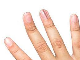 Las infecciones por hongos en las uñas se producen debido a diversos organismos fúngicos (hongos). Dermabia