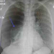 A spontaneous pneumothorax occurs with the rupture of a bleb. Pneumothorax Wikipedia