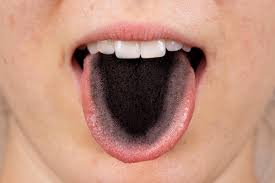 Image result for black hairy tongue symptoms