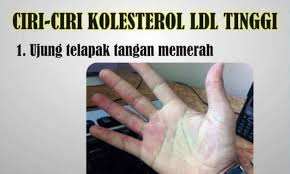 Namun apakah tanda kolesterol bisa dirasakan? Tanda Tanda Kolesterol Tinggi Sumber Makan Sedap Johor Facebook
