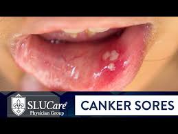 Image result for Canker sores roof of mouth