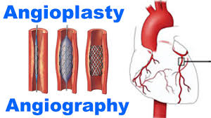 Hasil gambar untuk Angioplasty