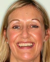 Damon Braces Fixed Braces