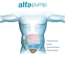 As mentioned earlier, the condition of fluid in lungs or pulmonary these are some of the best natural treatments on how to get rid of fluid in lungs naturally. How It Works Alfapump