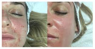 Led Light Therapy In Exeter Changing Faces