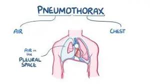 Image result for Open Pneumothorax