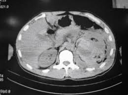 Image result for Perinephric Abscess