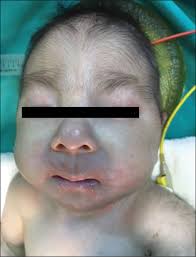 Book doctor appointment consult doctor online. Trisomy 18 Edwards Syndrome Causes Symptoms Life Expectancy Treatment