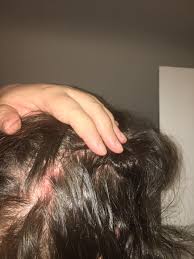 Lump on back of head. Help Needed R Popping I Have An Angry Lump On The Back Of My Head No Idea What It Is But My God It S Painful Lots Of Dead Yellowing Skin Around It And