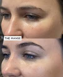 In cases where the eyebrow itself has hooded, then a forehead lift is warranted. Eyebrow Lifting Best Clinic Sydney For Dermal Fillers