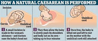 The Slow Caesarean That Is More Like A Natural Birth Daily Mail Online