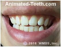 The influx and shifting of hormones can increase blood flow to the gums, making them more susceptible to inflammation. Can Wisdom Teeth Cause Front Tooth Crowding What Research Says