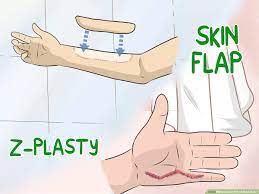 3 Ways To Get Rid Of Burn Scars - Wikihow
