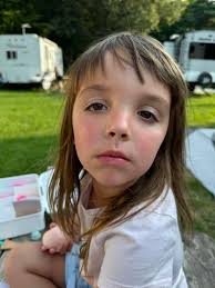 Fifth disease virus symptoms and precautions