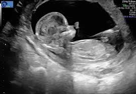 Ab wann ist das geschlecht überhaupt erkennbar? Sieht Man Welches Geschlecht Babyforum At
