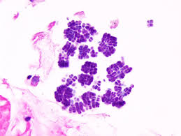 A synthesizer of microbial cellulose, various members of the genus are human flora and may be found in the skin and. Arp Press On Twitter Lovely Example Of Sarcina Ventriculi Involving Gastric Mucosa Https T Co Uu8qv9petx Dr Dora Lam Himlin S Series Pmid 21997690 Https T Co Zodzr9aba3